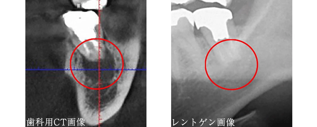 歯科用CTによる精密検査