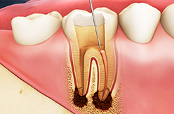 虫歯・精密根管治療