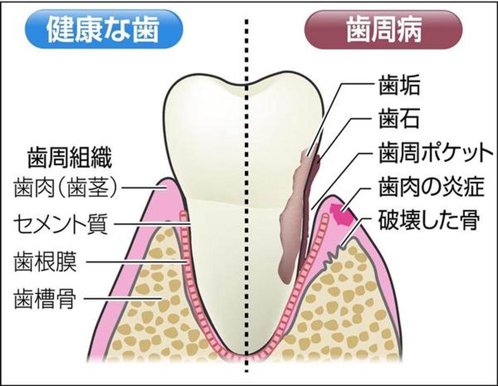 歯周病