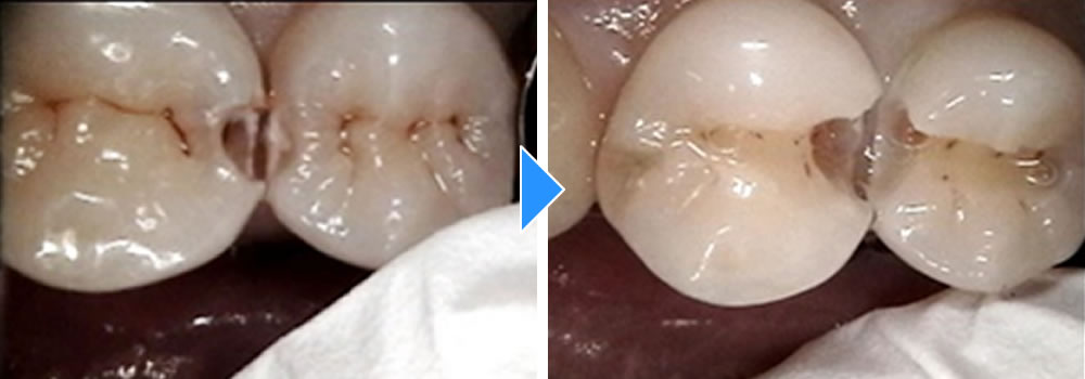 虫歯の除去