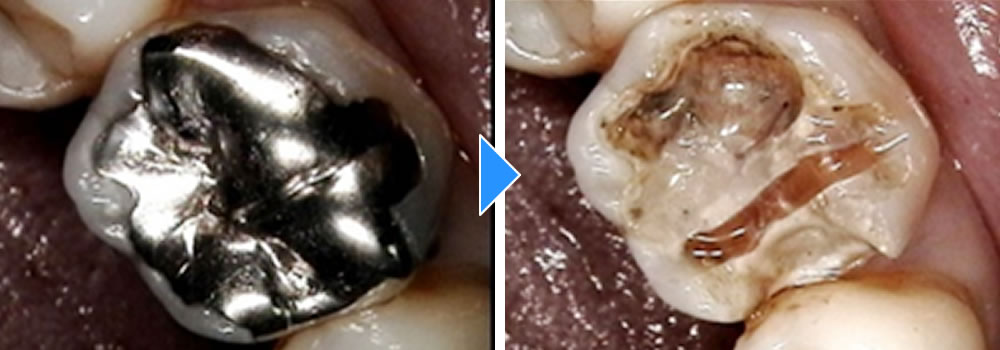 銀歯の除去