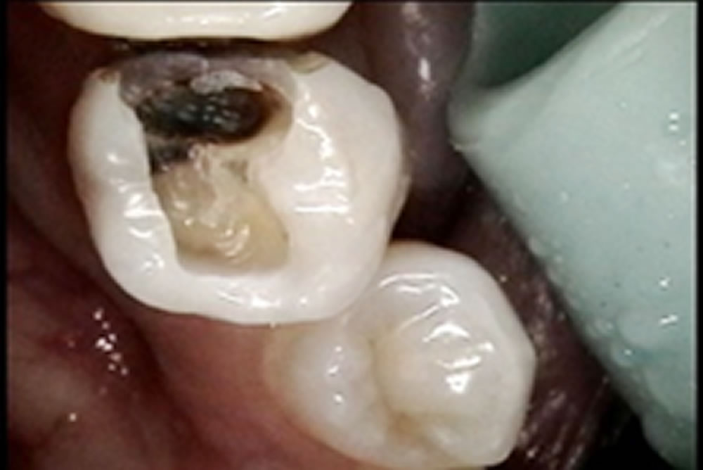 保険のつめ物の除去・虫歯治療の実施