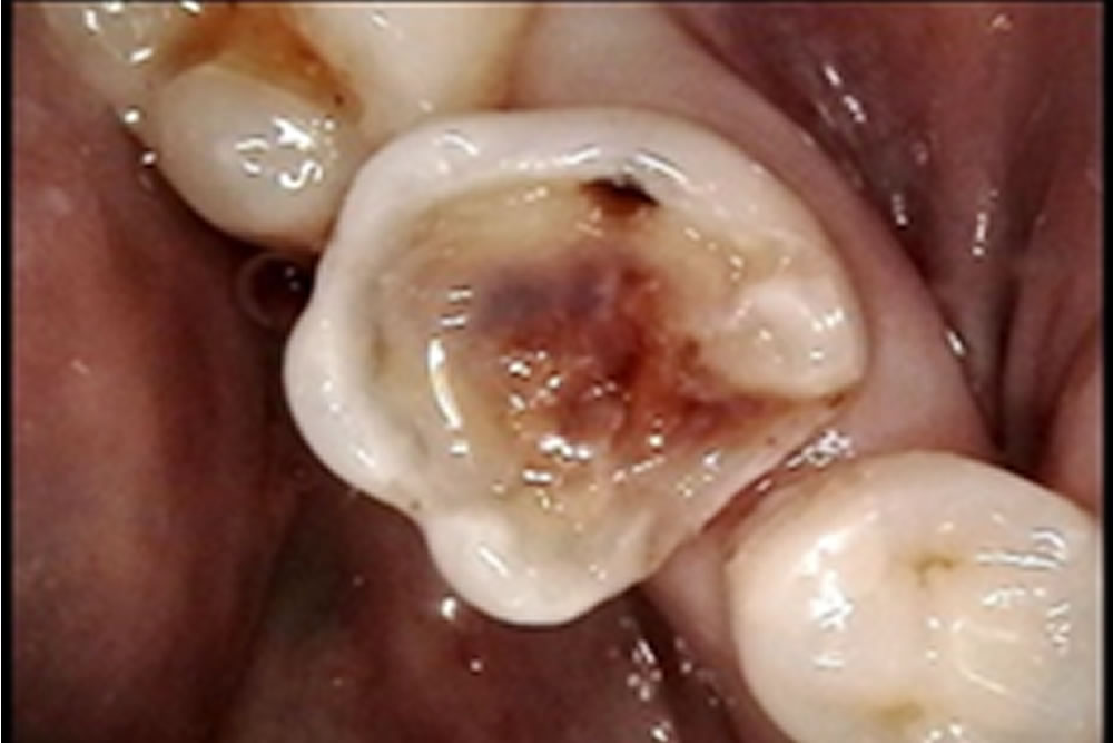 セラミックインレーの除去・虫歯治療の実施