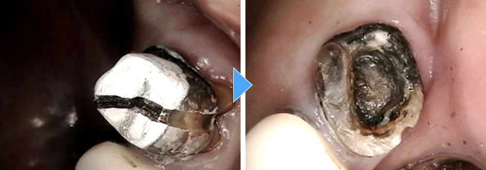 銀歯の除去・根管治療の実施