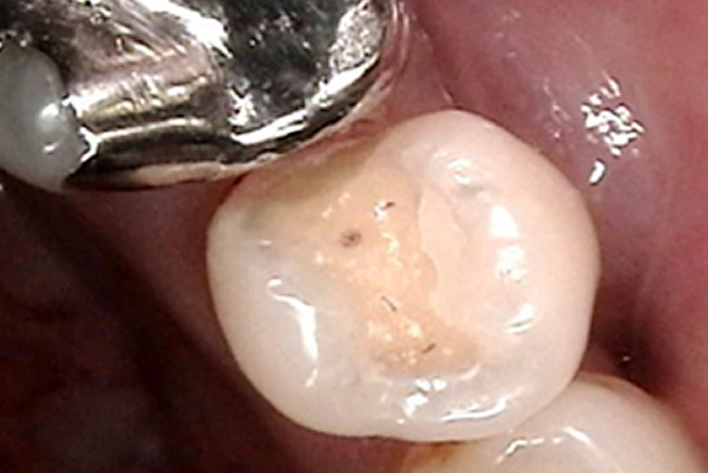銀歯の除去・むし歯治療の実施