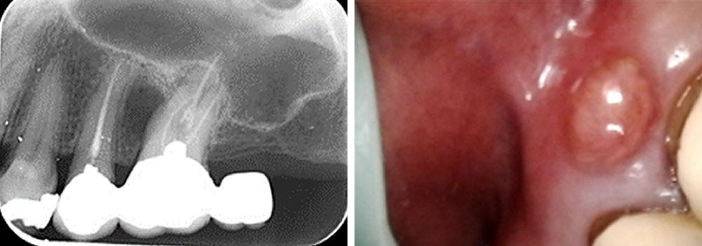 ブリッジの支台歯に実施した根管治療の症例