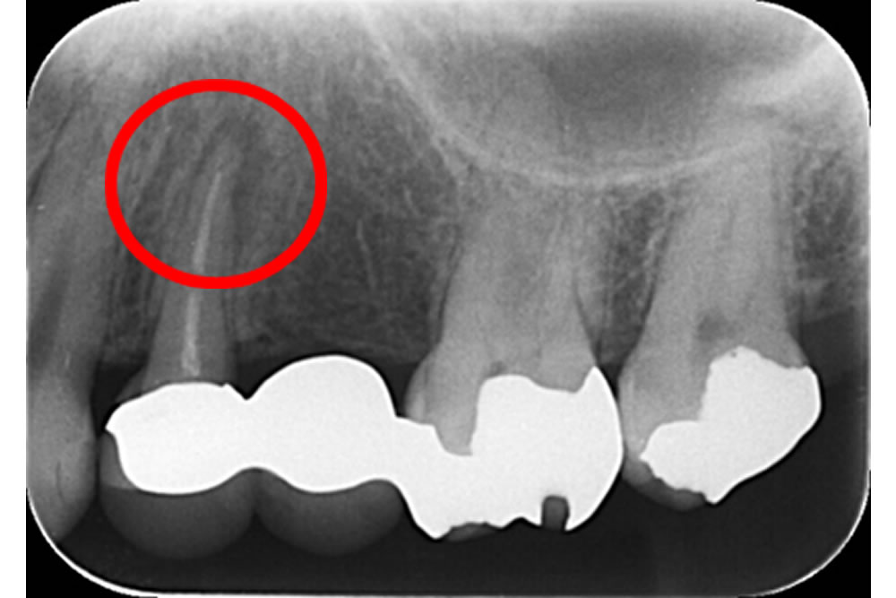 初診時のレントゲン