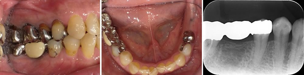 初診時の口腔内