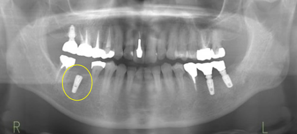 インプラント埋入後のレントゲン画像