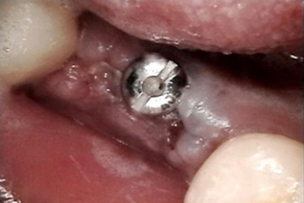 歯茎の形成・型取り