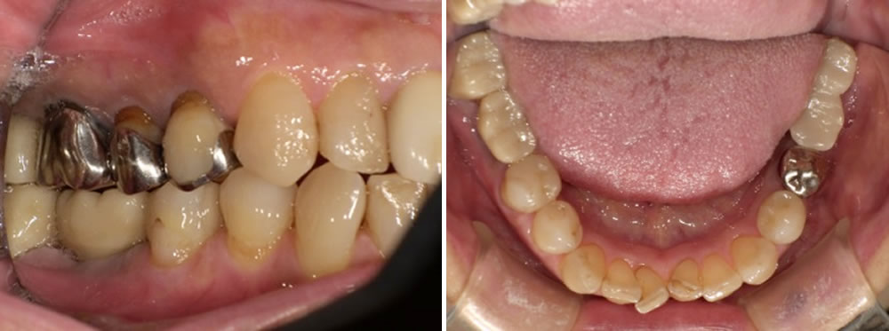 かぶせ物の装着・治療完了