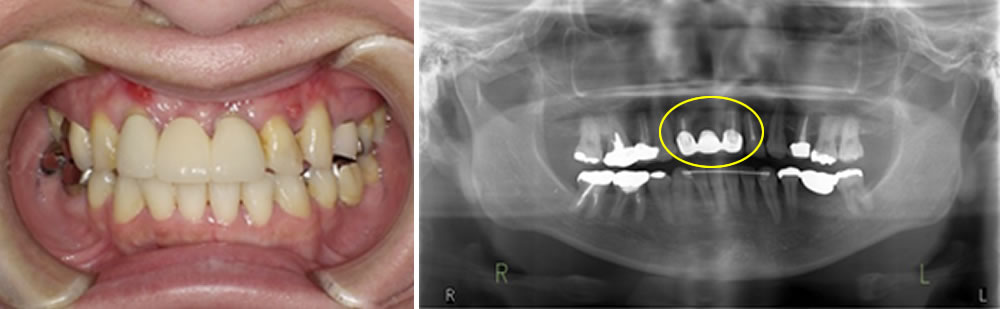 初診時の口腔内