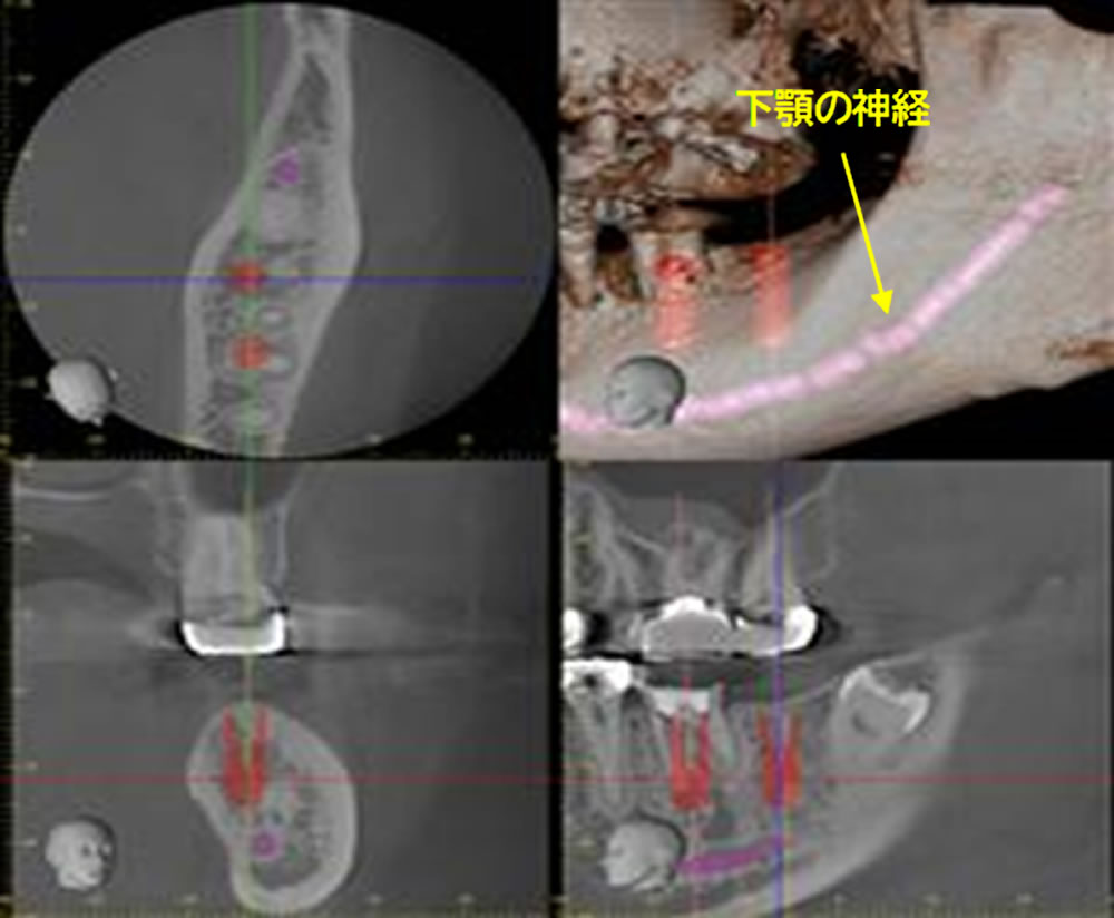 インプラント埋入のシミュレーション