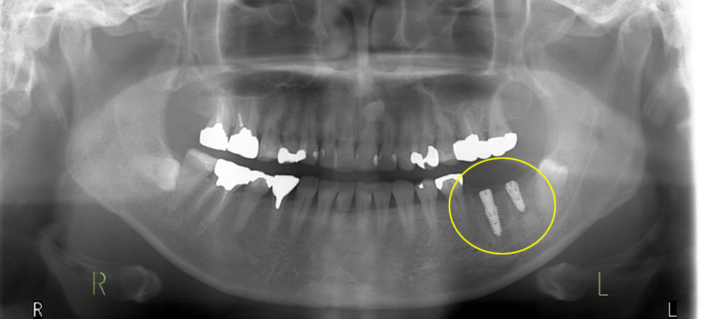 インプラント手術の実施
