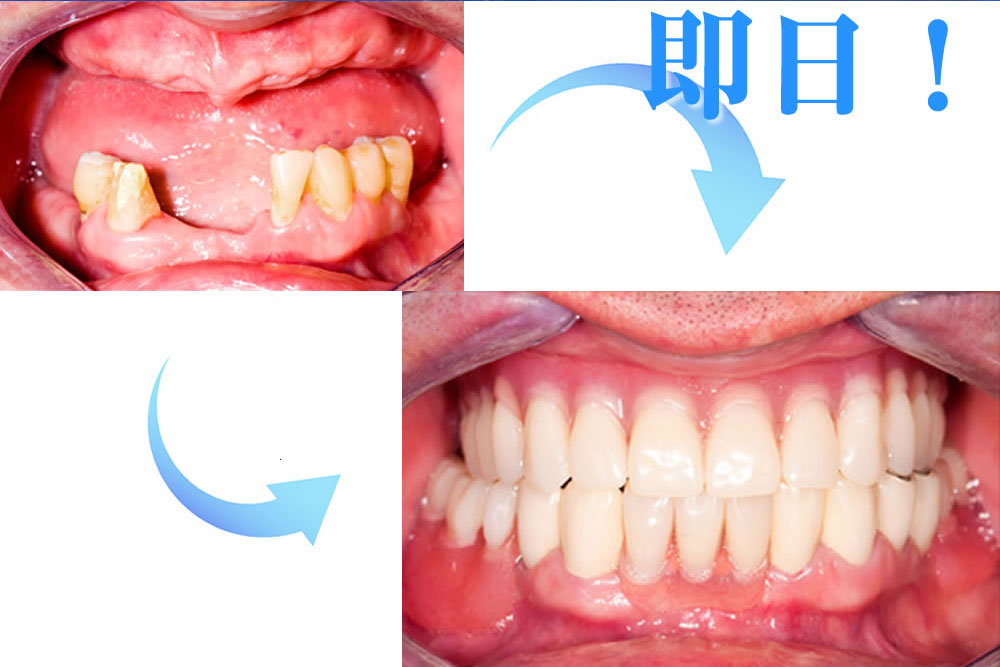 抜歯即時埋入法