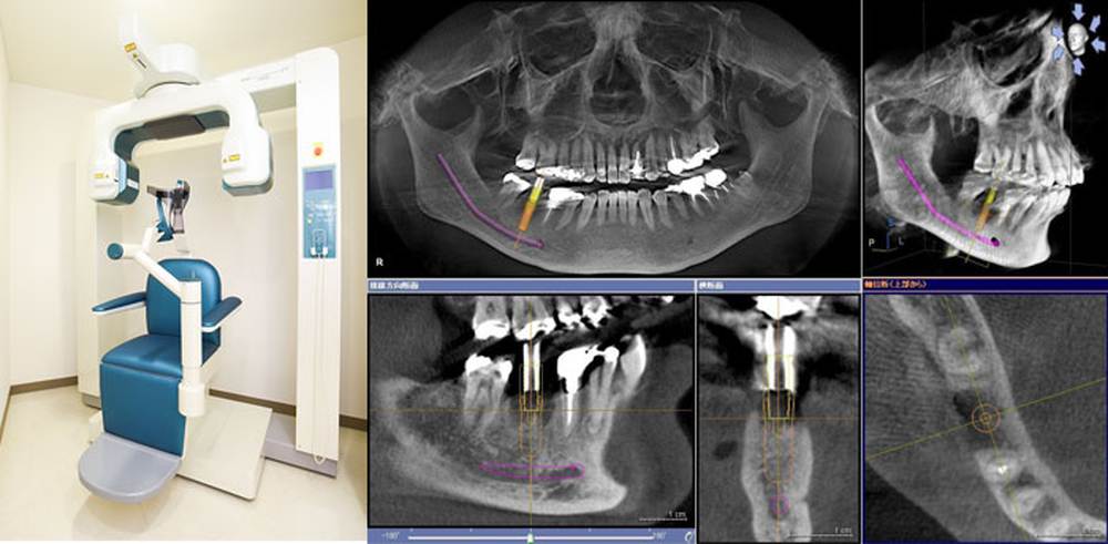 歯科用CT