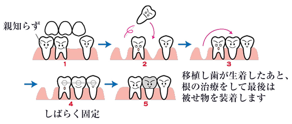 歯牙移植